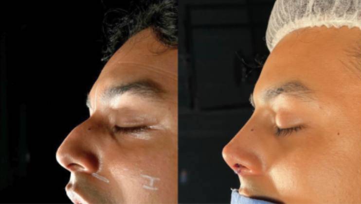 tratamiento para Desviaciones septales Otorrinolaringólogo en Naucalpan