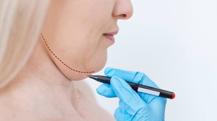 Liposucción cervical y marcaje mandibular Otorrinolaringólogo en Naucalpan