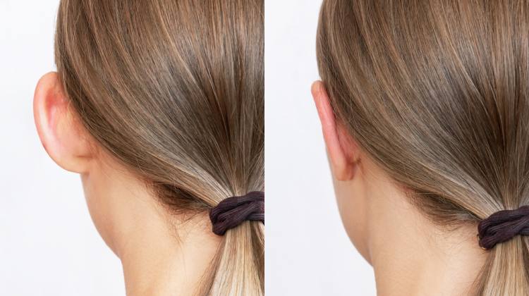 Otoplastia Otorrinolaringólogo en Naucalpan