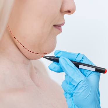 Liposucción cervical y marcaje mandibular en Naucalpan